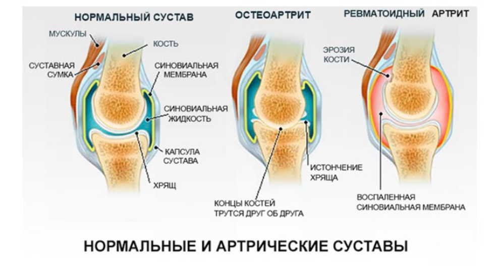 Раньше нестерпимо болели колени, НО ТЕПЕРЬ уже несколько лет забыла о боли! Рецепт раскрыт!